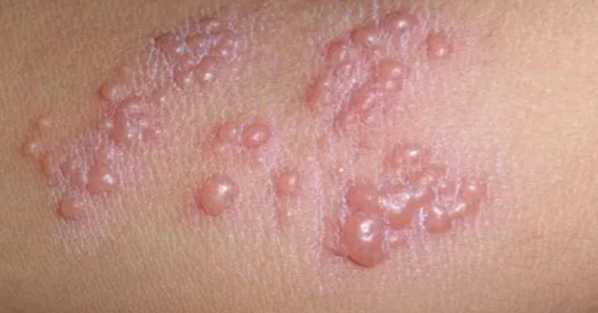 Herpes zoster disease caused by high levels of stress