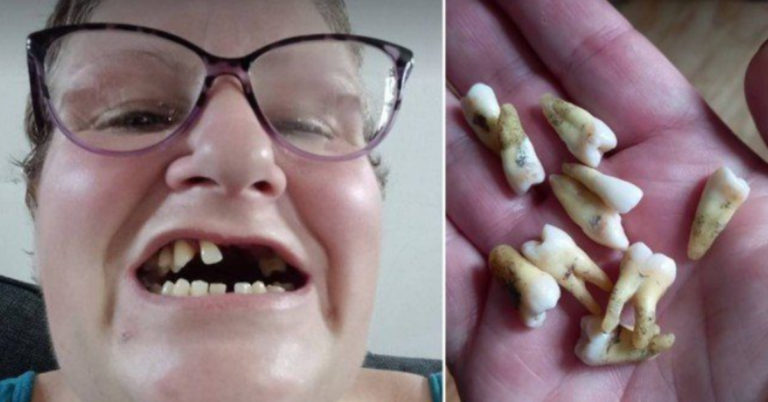 Sem vaga no Sistema de saúde pública, sem dinheiro para ir ao dentista, mulher arranca 11 dentes sozinha: “Não havia outra escolha, foi no desespero”